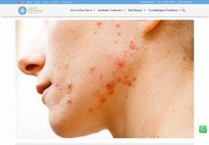 Acne Clinic in Singapore | APAX Medical & Aesthetics Clinic - Acne Clinic in Singapore with clinically effective treatment options. Early treatment of acne reduces permanent scarring.