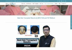 Hair Transplant Result - Hair transplant is a surgical procedure and it is the surgeon who is the most important for the success of the surgery. Rejuvenate Centre offers the high-quality FUT,  FUE and BHT method for best hair transplant Result.
