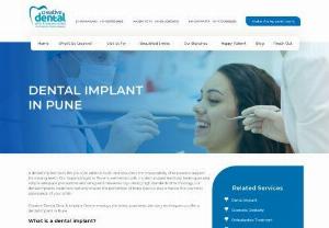Regain your beautiful smile with the implant dentistry treatment - At Creative Dental Clinic and Implant Center, we guarantee strictly follows to safety protocols and give superb consideration to patients requiring a dental implant. We guarantee the customization of every single dental methodology that is exceptionally OK & pocket-friendly

