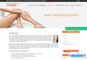 Spider vein treatment - Suffering from Spider vein but don't know what exactly it is and how to treat? Visit Karishma Vein Clinic to know the best treatment for your vein problem. Karishma Vein Clinic also provides laser treatment for spider veins.
