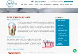 Affordable and reliable dental implants in Mumbai 2020 - Spaceline dental is a well established and reputed dental clinic in Mumbai.  We offer dental implants services at an affordable price that include single tooth implants, multiple tooth implants, full mouth implants, sinus lifting, etc.