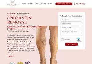 Vein Restoration - Spider veins are small red,  purple blood vessels that appear on the legs,  thighs,  ankles,  and face. Sclerotherapy is a quick and painless procedure for spider vein restoration and elimination. These have an exciting impact on your appearance,  and the specialists of Beverly Hills Med Spa help you restore your smooth and youthful appearance.