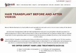 Hair transplant before and after - Hair loss is a fundamental problem these days which affect people of all gender. Beverly Hills provides you with the best hair loss treatment at very low costs. We also provide video footage of the hair transplant before and after results, so you\'re 100% satisfied that our procedure is completely authentic.
