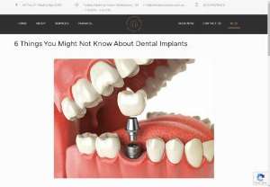 Dental implants - If your dentist near me has suggested that you get dental implants, it's important to understand what it is are and what surgery involves.