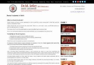 Best Dental Implants Treatment in Delhi - Dr. Jetley is a sought Implants Dentist, One of the prominent dentists in Delhi, India. He has his own clinic in Defence Colony where all your dental treatments are taken care of. He has 37+ years of experience in the field of Dental Implants and Cosmetic Dentistry. He has a multidisciplinary clinic and strongly believes in providing world-class oral health treatment. Benefits of dental implants are- improved appearance, improved speech, natural look, improved comfort, easier eating.