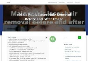 Male pubic laser hair removal before and after - Male pubic laser hair removal before and after
Hi, friends welcome our blog .you find male pubic laser hair removal before and after topic .all right I write this topic read now. you know if hair grows your bodyes then you face many problems .bassically our private areas hair such as bikini line, Brazilian, pubic area, etc.
this is 100% safe and gives long-term service .you are do not remove pubic hair frequently .which this service is not getting another hair removal treatment .