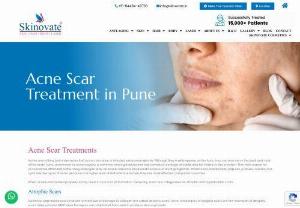 Skinovate provides the best acne scar treatment in Pune - Do you want acne and its scar-free look? Don't worry, at Skinovate; our specialist provides laser treatment to kill the bacteria from the acne area, leading to a smooth and scar-free face. To know more book your appointment with us.