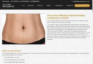Best Stretch Marks Treatment in Delhi - Laser treatment for stretch marks is a safe and non-invasive therapy that uses light energy to regenerate skin cells. Laser treatment helps in reducing the scarring of the stretch marks and makes the skin soft and flattened in appearance. There is no effective treatment for stretch marks other than laser treatment. Clinic Skin Essence provides the Best Laser Stretch Marks Removal Treatment in Delhi. The laser removes the outer layer of the skin, leaving newer and smoother skin.