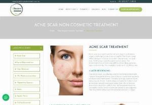 Acne Scar Non Cosmetic Treatment - Restore Clinics provides best acne scars removal treatment. Get acne treatment from leading cosmetic surgeon. Call us for an appointment.