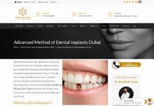 Dental Implants in Dubai - A dental implant is a metal publish that replaces the root part of a missing enamel. An synthetic teeth (crown) is located on an extension of the publish (abutment) at the dental implant, giving you the appearance of a real enamel