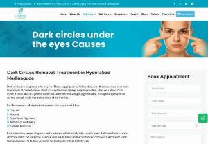Dark Circles Removal Treatment in Hyderabad - Dark circles may worry you continuously. Dark Circles Removal Treatment in Hyderabad helps you reduce dark circles under the eyes. 100% safe and effective treatments.