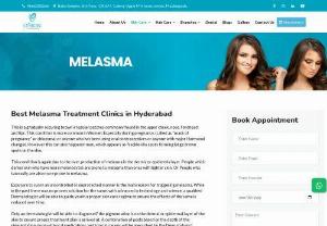 Best Melasma Treatment Clinics in Hyderabad - Melasma can be treated with skin lightening creams based on the type of colour& pigmentation visit the Best Melasma Treatment Clinics in Hyderabad and make your skin worth of it