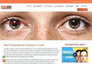 Treatment for Freckles in India - Do you want to get rid of freckles on the face? Read here to know the causes, types, signs along with the treatments for freckles and their cost.