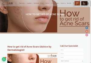 How to get rid of Acne Scars practical advice - We all have been through this: Its the morning of a big date or an important meeting. You look in the mirror, and what do you see? A breakout!