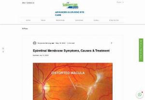 Epiretinal Membrane Symptoms, Causes & Treatment Sanjeevan Netralaya - Unlock the mysteries of Epiretinal Membrane and its impact on vision. Explore the symptoms, causes, and cutting-edge treatments.