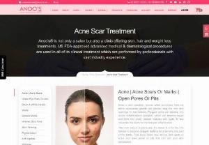 Acne Removal Treatment at Anoos: Reveal Your Best Skin - Discover flawless, acne-free skin with Anoos' Acne Removal Treatment. Our expert dermatologists offer personalized solutions with advanced technology and medical-grade products. Achieve clear, radiant skin, and boost your confidence. Book your consultation now!