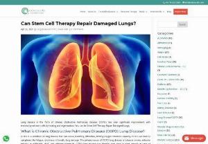 Stem Cell Therapy for COPD - COPD is a condition of lung disease that can cause breathing difficulties, limiting oxygen retention capacity. COPD can lead to symptoms like fatigue, shortness of breath, and lung damage.  Stem cell treatment for lung diseases has become the best alternative treatment regime.