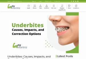 Underbites: Causes, Impacts, and Correction Options - What is an Underbite?  An underbite, also known as mandibular prognathism, is a common condition characterized by misalignment between the upper and lower rows of teeth. An underbite occurs when the lower jaw extends outward farther than the upper jaw. This causes the lower front teeth to sit in front of the upper front teeth when you bite down. About 5% of the global population has some form of underbite.