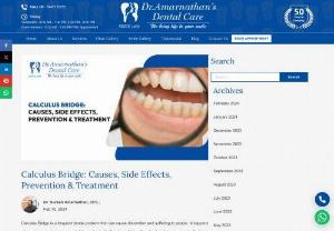 Calculus Bridge: Causes, Side Effects, Prevention & Treatment - Calculus Bridge is a frequent dental condition that can cause discomfort and pain. It happens when plaque and germs accumulate on the teeth, creating a bridge-like structure between two teeth. Understanding the fundamentals of calculus bridges can help people take proactive steps to safeguard their teeth and keep a healthy smile.