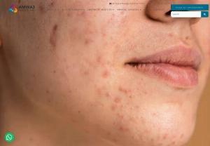 Acne Scars Treatment in Dubai - Amwaj Polyclinic - An acne scar is a mark or indentation left on the skin after an acne lesion has healed. These are typically the result of inflammation and damage to the skin's collagen during the healing process of acne lesions.They didn't have serious health consequences, but they can harm your self-esteem, which is never a good thing. To avoid struggle with acne's scarred pits and undulations. Book an appointment for Acne Scars Treatment in Dubai - Amwaj Polyclinic where...