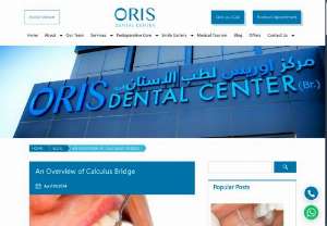 An Overview of Calculus Bridge | Calculus Bridge Dental - Are you struggling with a dental calculus bridge in your teeth? Don&#039;t worry. Here, you can find the best solution for get rid of plaque on teeth.